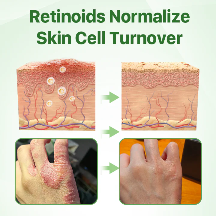 Fivfivgo™ Psoriasis Relief Crocodile Oil Soap