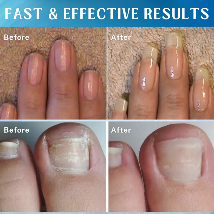 Fivfivgo™ Nagelwachstum Serum Stift