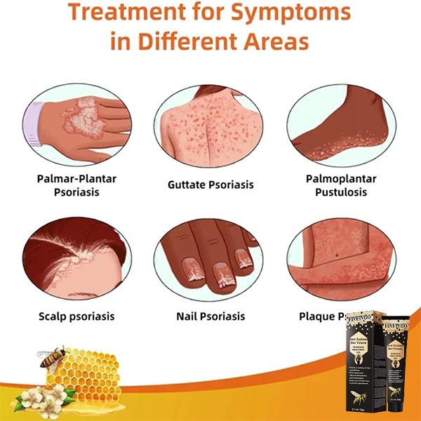 Fivfivgo™ New Zealand Bee Venom Psoriasis -hoitogeeli