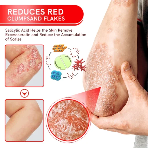 Fivfivgo™ Spray zur Behandlung von Bienengift-Psoriasis mit mehreren Symptomen
