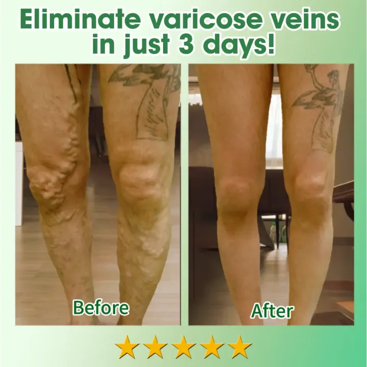 Fivfivgo™ 30 Herbal Firming Slimming & Detox Foot Bath Beads (Effective Treatment for High Blood Sugar and Arthritis)