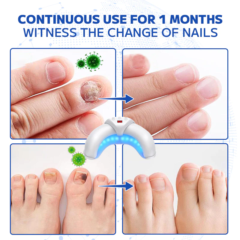 Fivfivgo™ Lasergerät zur Behandlung von Nagelpilz