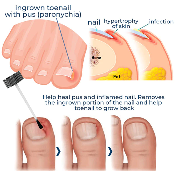 Fivfivgo™ Nail Fungus Treatment Gel