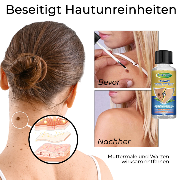 Fivfivgo™ TAGAway Lösung zur Entfernung von Muttermalen und Warzen
