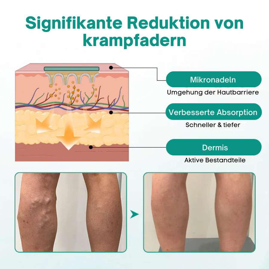 Cvreoz® LegRenew Krampfadern-Patch