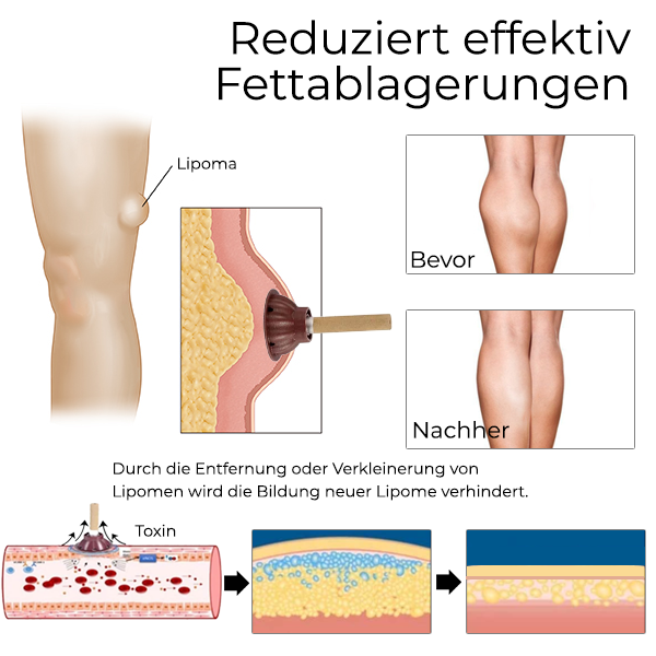Fivfivgo™ Bioactive Moxibustion Lipom Heilung Stick