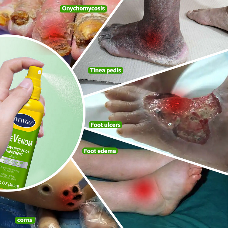 Fivfivgo™ BeeVenom FungiVanish Behandlungsspray