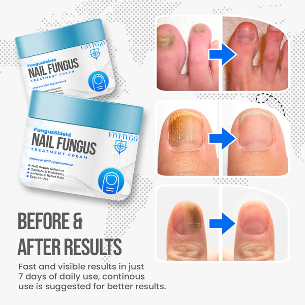 Fivfivgo™ FungusShield Nagelpilz-Behandlungscreme