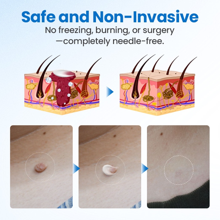 Fivfivgo® TagGone Wart Removal Cream