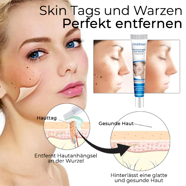 Fivfivgo™ Creme zur Entfernung von Hautflecken und Warzen
