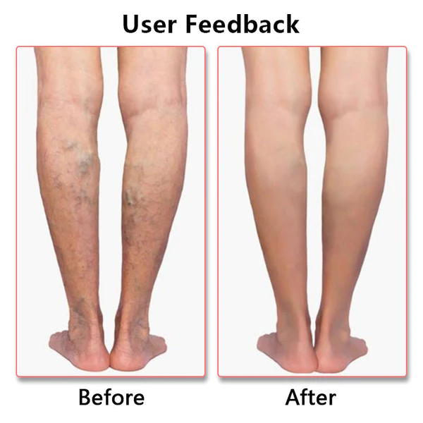 Fivfivgo™ Varicose Premium Compression Stockings