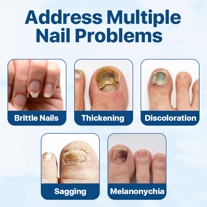 Fivfivgo™ Candiclear Nail Fungus Treatment Cream