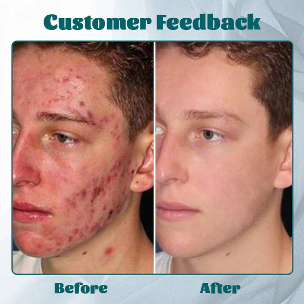 Fivfivgo™ Crème Hydra AcneFree pour Hommes