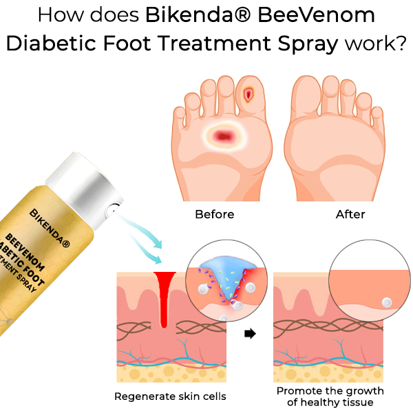 Bikenda® BeeVenom Diabetic Foot Treatment Spray