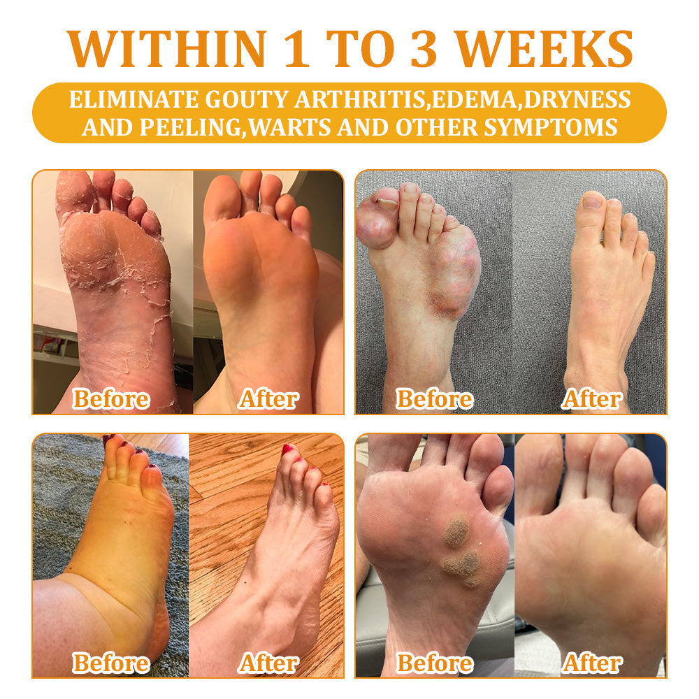 Fivfivgo™ Bee Venom & Herb Detox Foot Bath Pearls with 30 Medicinal Plants | 👨‍⚕️✅For General Obesit, Varicose Veins, and Joint Pain