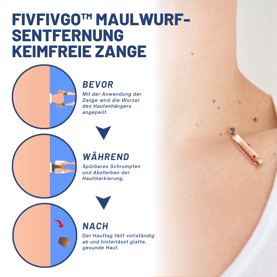 Fivfivgo™ Maulwurfsentfernung Keimfreie Zange