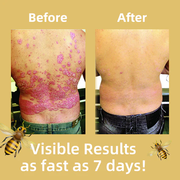 Fivfivgo™ Bee Venom Psoriasis Treatment Cream