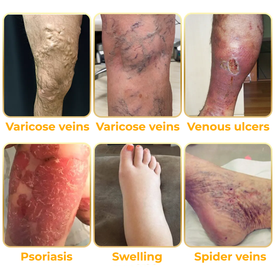 Fivfivgo™ Creme zur Behandlung von rheumatoider Arthritis und Krampfadern