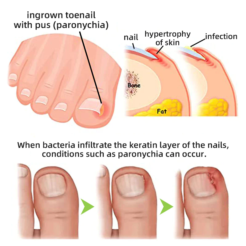 Fivfivgo™ Nagelpilz-Lasertherapiegerät Max