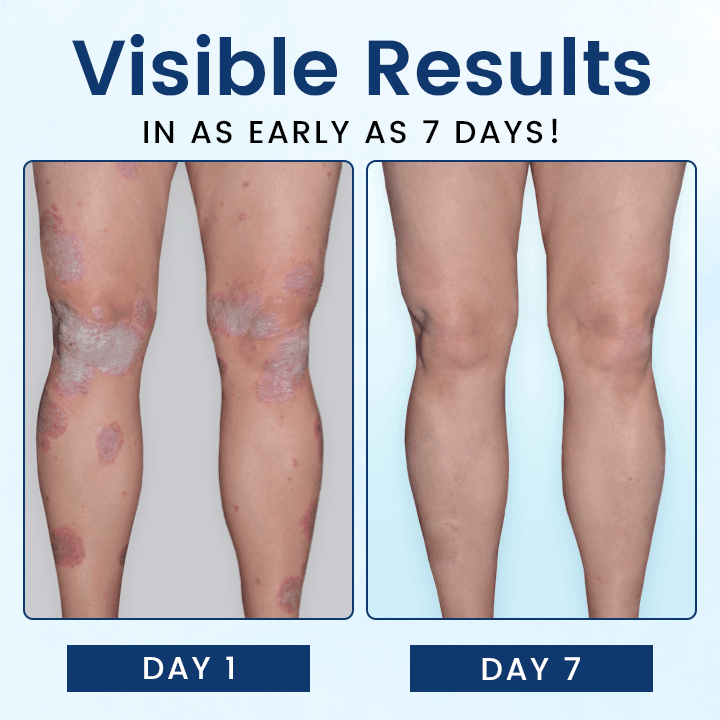 Fivfivgo™ SootheGlow Psoriasis-Behandlungscreme