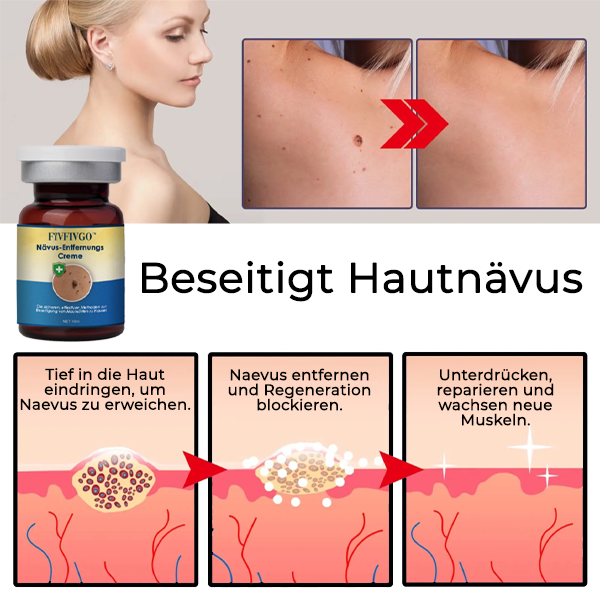 Fivfivgo™ Nävus-Entfernungs-Creme