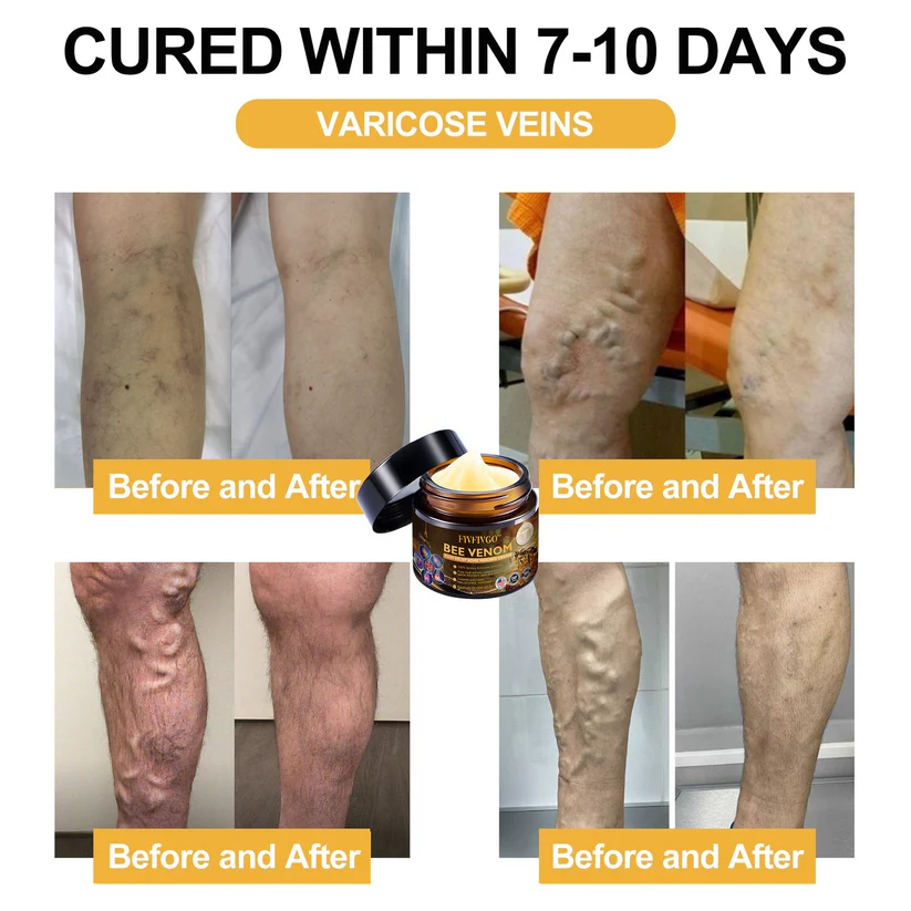 Fivfivgo™ Bee Venom Arthritis Therapy Cream (Specially for older adults & AAOS recommends)