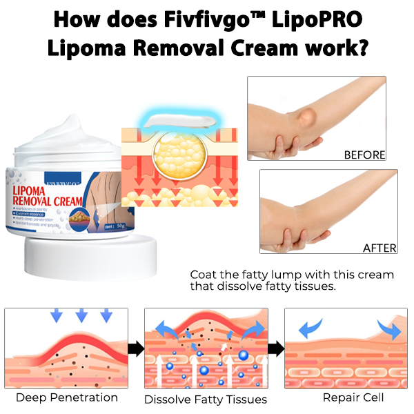 Fivfivgo™ LipoPRO Lipom-Entfernungs-Creme