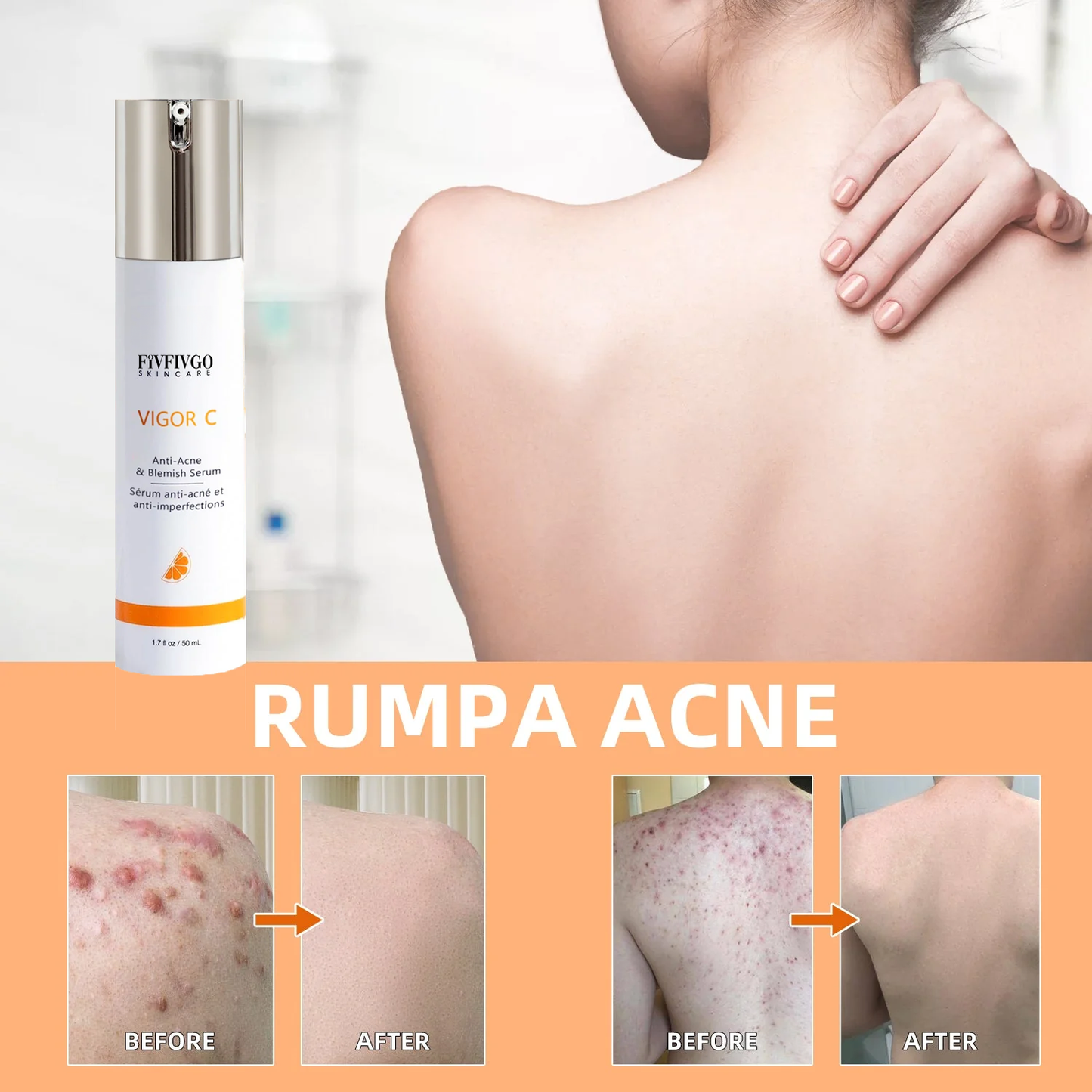 Fivfivgo™ VIGOR C Pakarat akne poistava seerumi (Akne & läiskät & Acanthosis Nigricans poisto)
