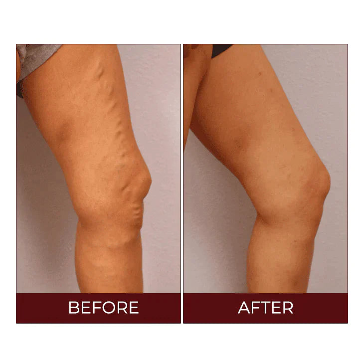 Fivfivgo™ Crema sollievo vene varicose