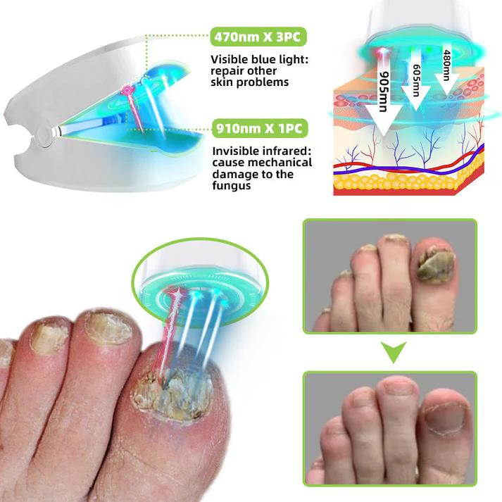 Fivfivgo™ Dispositif de traitement au laser des mycoses de l'ongle
