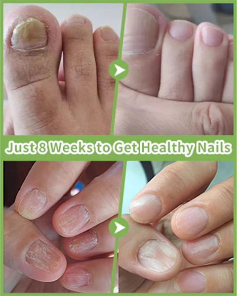 Fivfivgo™ Antimykotisches Lasergerät