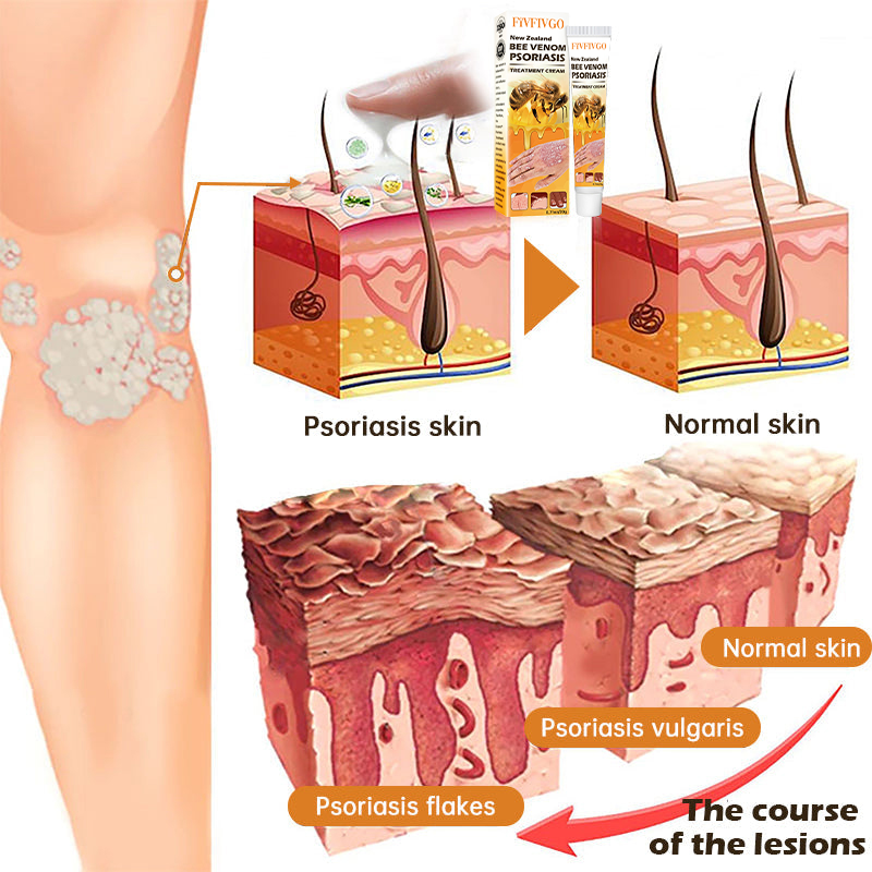 Fivfivgo™ Neuseeland Bienengift Psoriasis Behandlung Creme