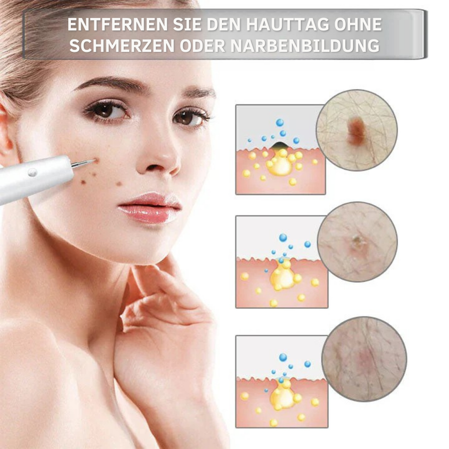 Fivfivgo™ Tragbarer Laser-Spot-Reinigungsstift