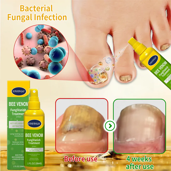 Fivfivgo™ BeeVenom FungiVanish-Behandlungsspray👨‍⚕️ (Fördert die Nagelregeneration, beseitigt wirksam Nagelpilz, Fußpilz und Fußgeschwüre)