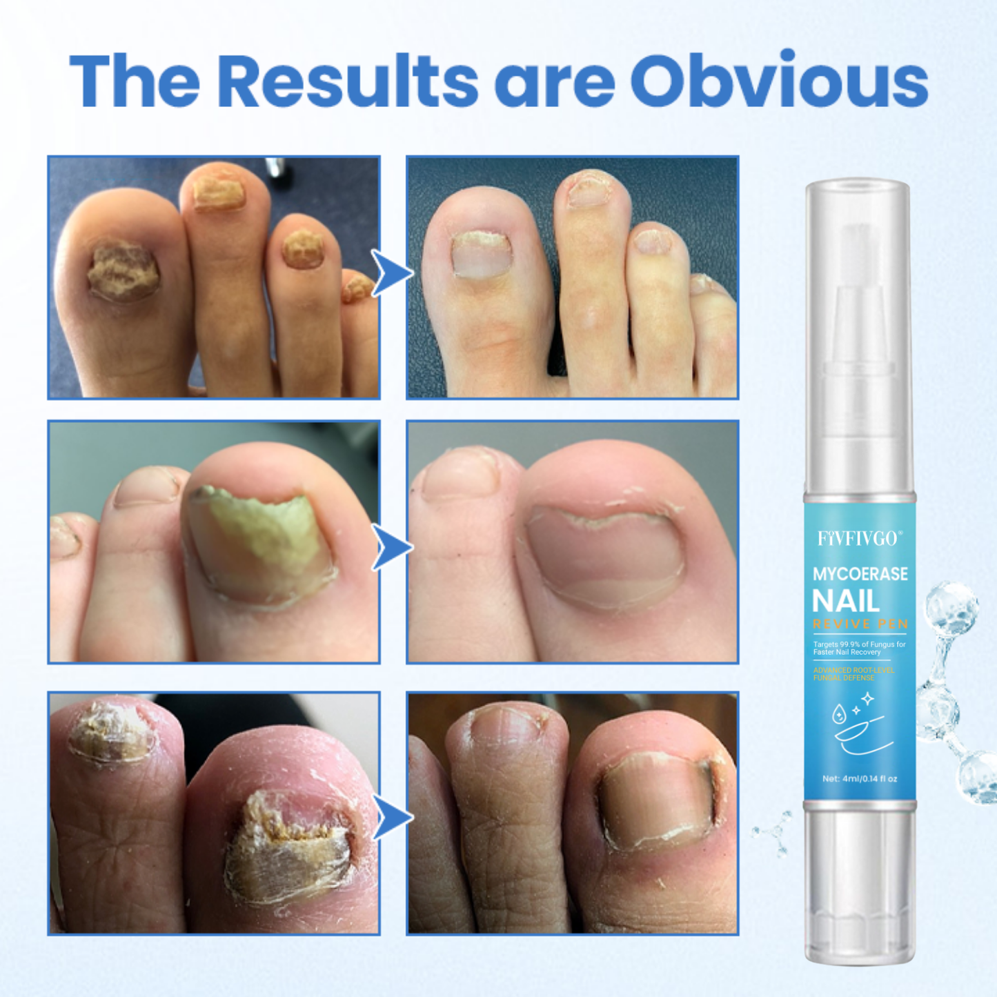 Fivfivgo® MycoErase Nail Revive Pen