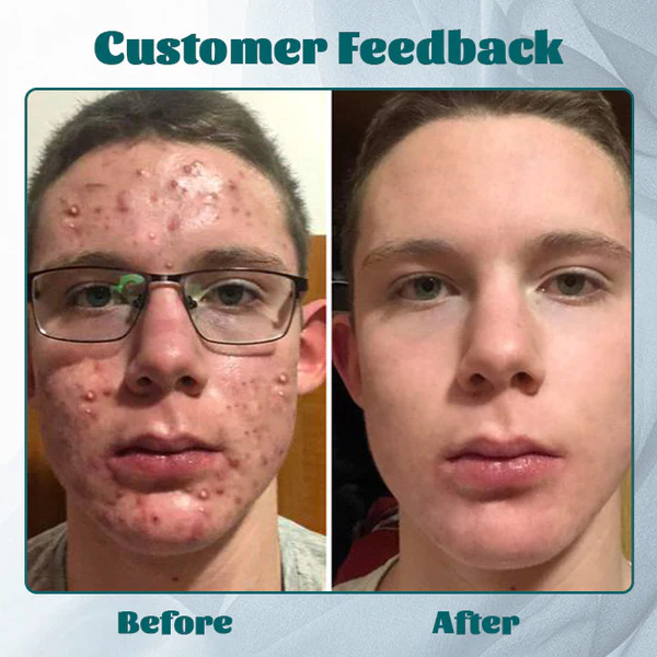 Fivfivgo™ Crème Hydra AcneFree pour Hommes
