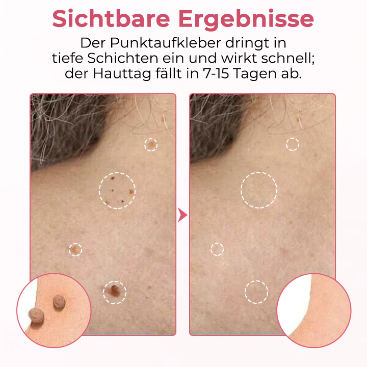 Fivfivgo® Schmerzfreies Mikro-Warzenentfernungspflaster