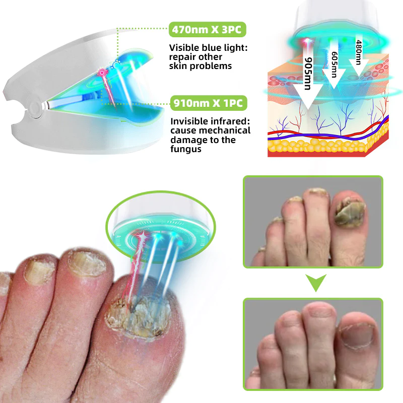 Fivfivgo™ Nail Fungus Laser Therapy Device Max