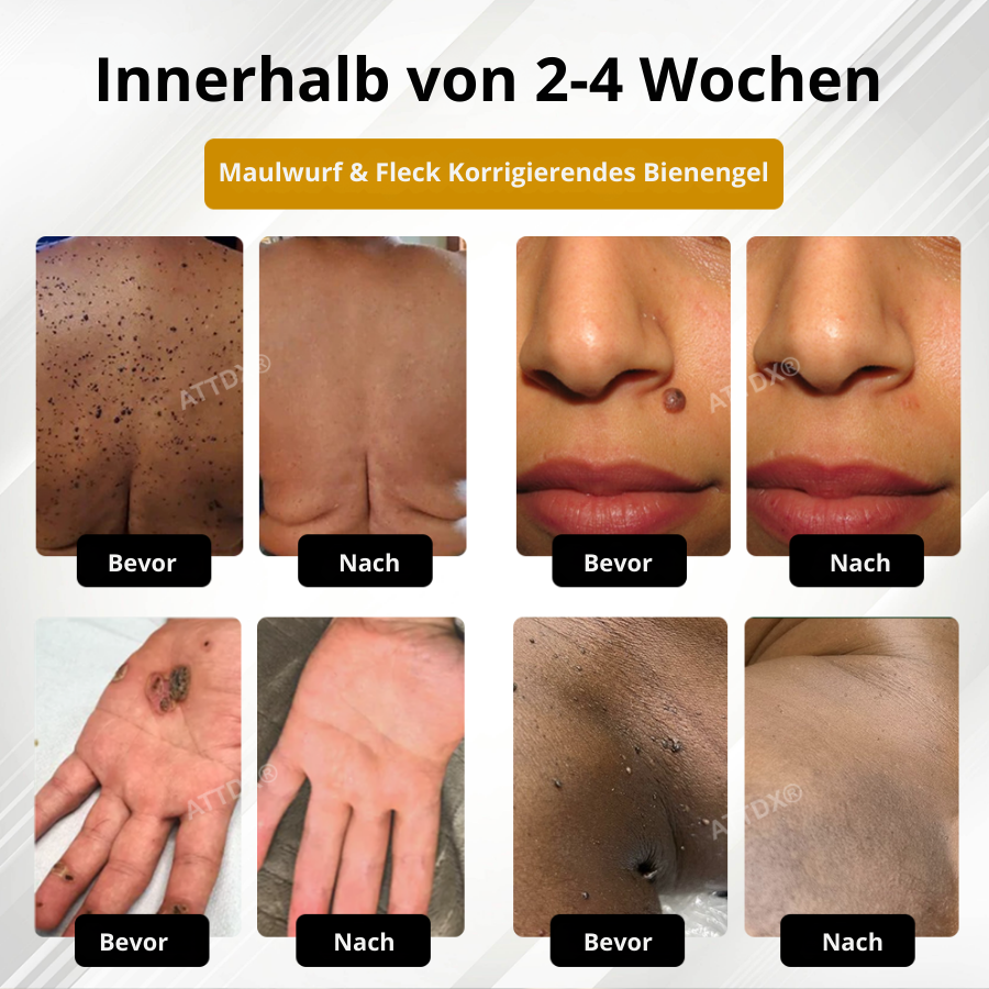 Fivfivgo® Fortschrittliches Maulwurf & Fleck Korrigierendes Bienengel