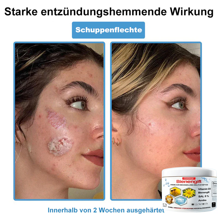 Fivfivgo™ Bienengift Creme Zur Behandlung Multi-symptom