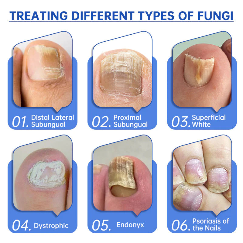 Fivfivgo™ PureNail Fungus Laser Therapy Device