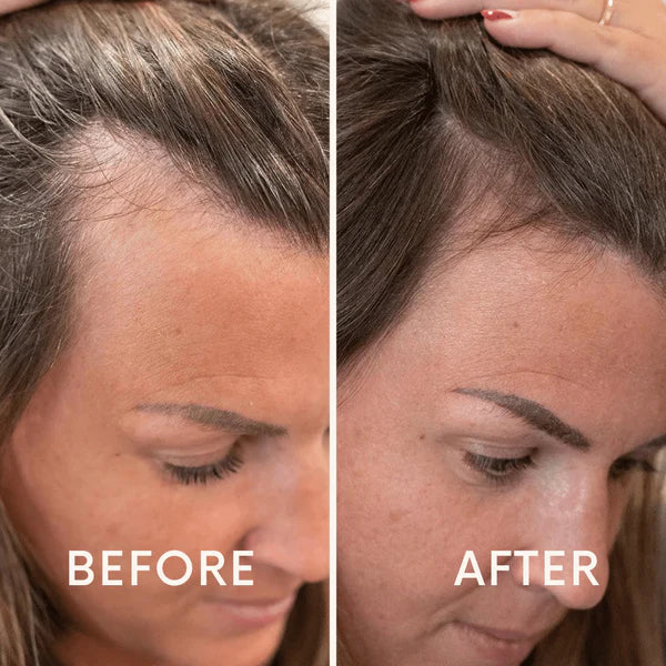 Fivfivgo™ Mobile Laser Therapy Cap pour la repousse des cheveux