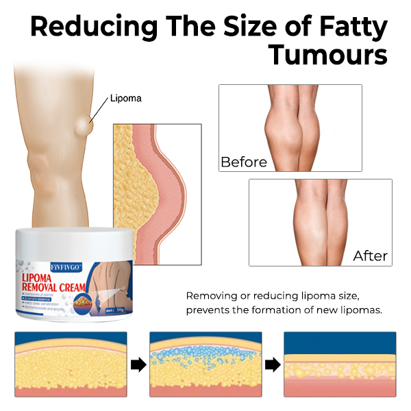 Fivfivgo™ LipoPRO Lipom-Entfernungs-Creme