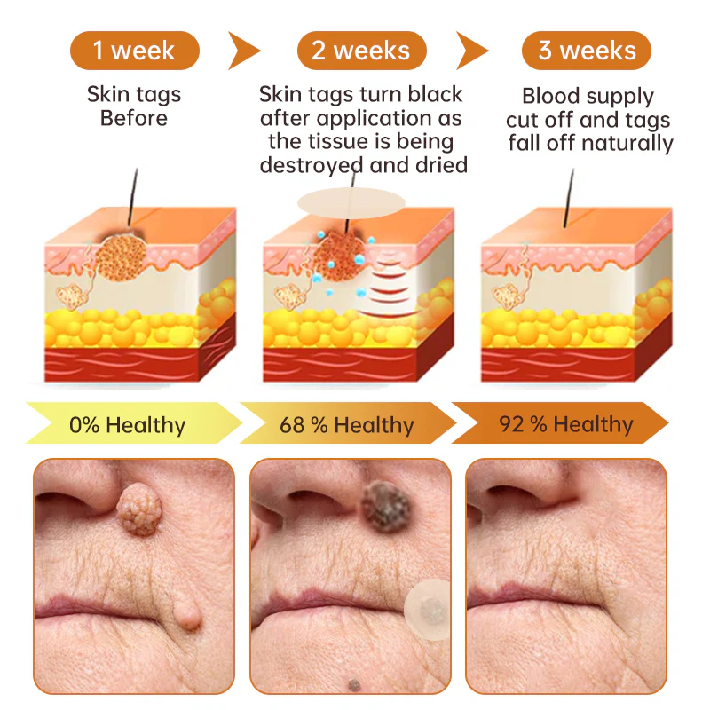 Fivfivgo™ WartGone Bienengift-Behandlung Patch