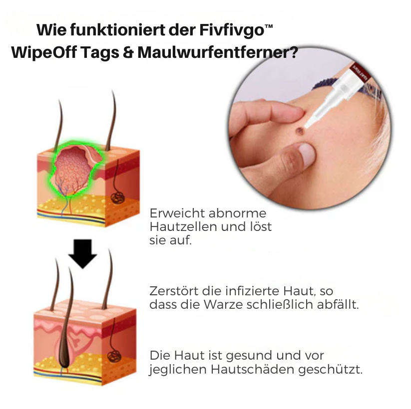 Fivfivgo™ WipeOff Tags & Maulwurfsentferner