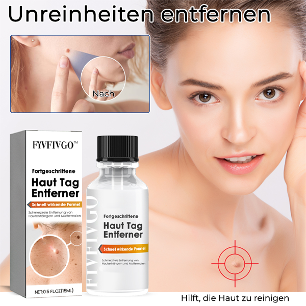 Fivfivgo™ Fortgeschrittene Haut Tag Entferner - Schnell wirkende Formel