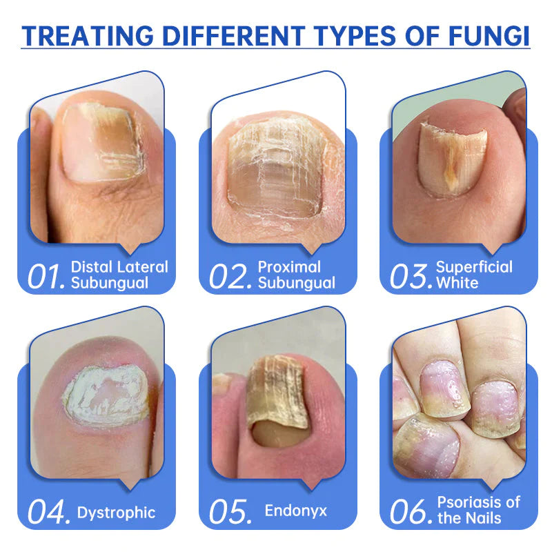 Fivfivgo™ PureNail Fungus Laser Therapie Gerät