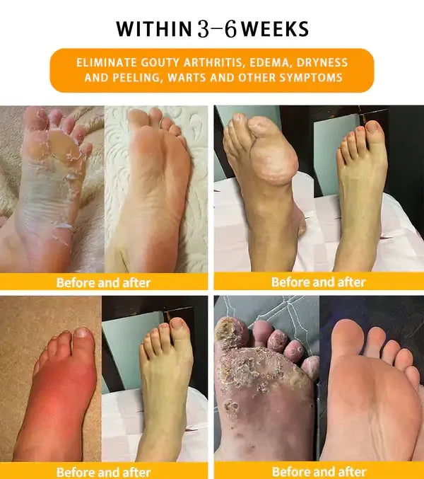 Fivfivgo™ 30 Herbal Firming Slimming & Detox Foot Bath Beads (Effective Treatment for High Blood Sugar and Arthritis)