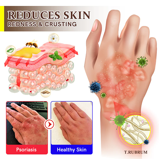Fivfivgo™ Spray zur Behandlung von Bienengift-Psoriasis mit mehreren Symptomen