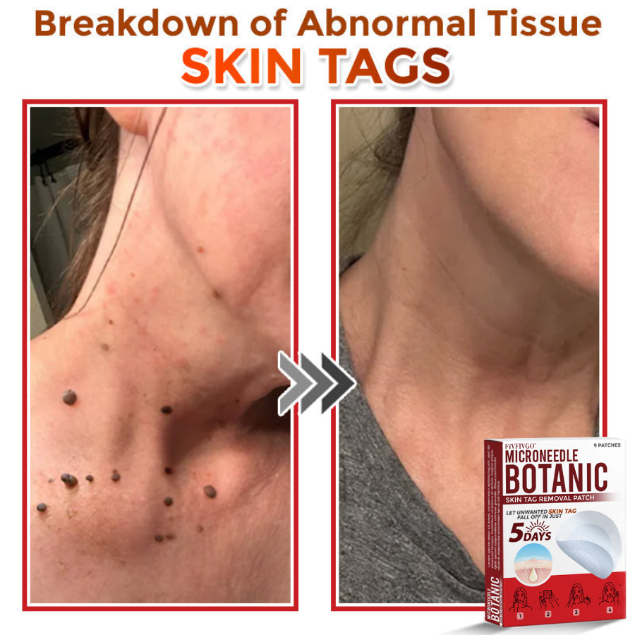 Fivfivgo® MicroNeedle Botanic Skin Tag Removal Patch 🇺🇸 Made in the USA